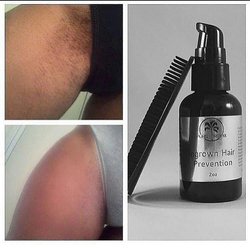 Ingrown hair