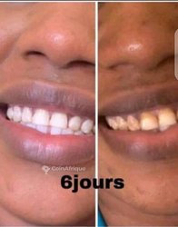 Blanchisseur de dents 